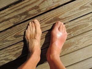 Effects of gout